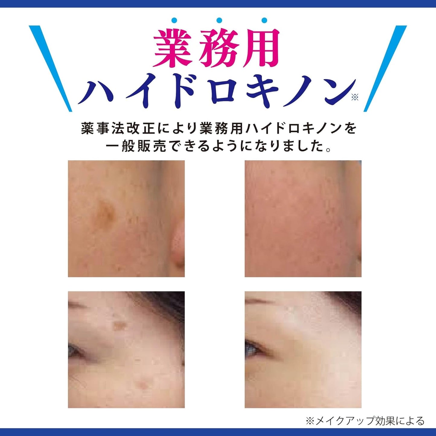 아사히 연구소(旭研究所) 업소용 하이드로퀴논 5% 크림 대용량 15g (의사 관리 하 사용)